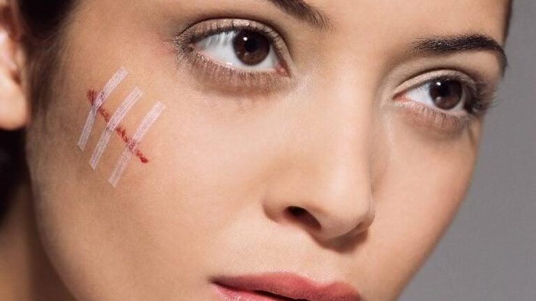 Tırnak pisti nasıl geçer? Yüz ve ciltte tırnak işaretleri nasıl yok edilir?